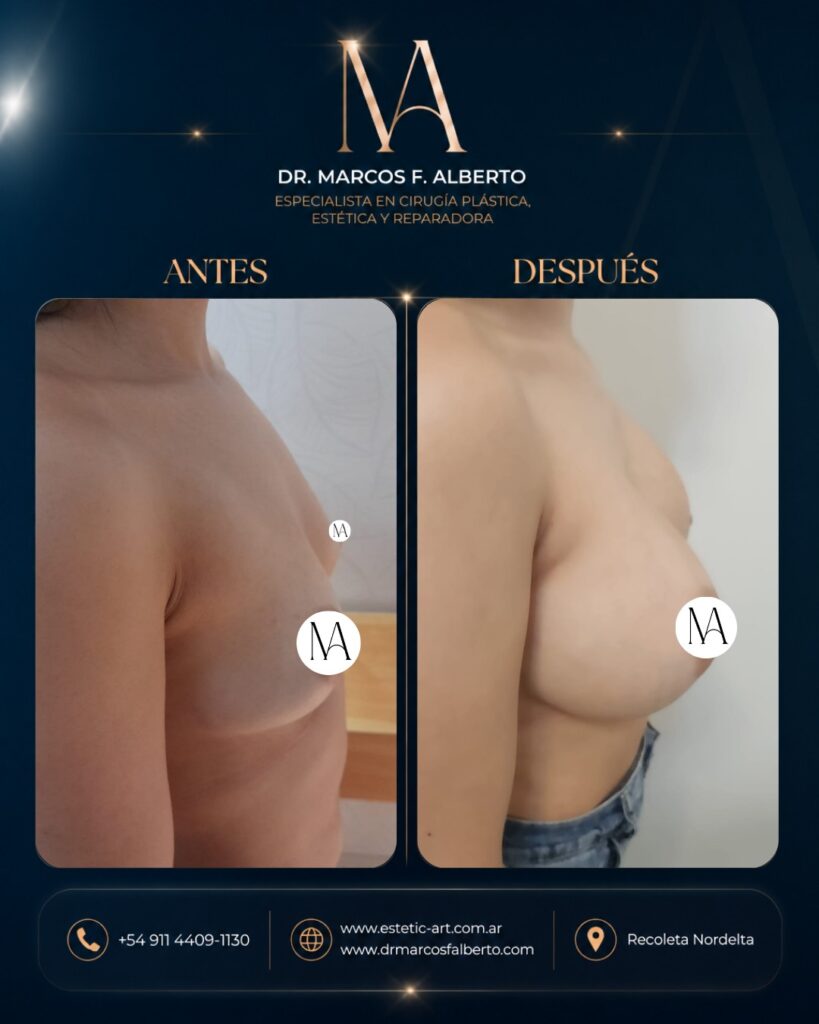 Antes y después de aumento mamario realizado por el Dr. Marcos Fernando Alberto – caso 10
