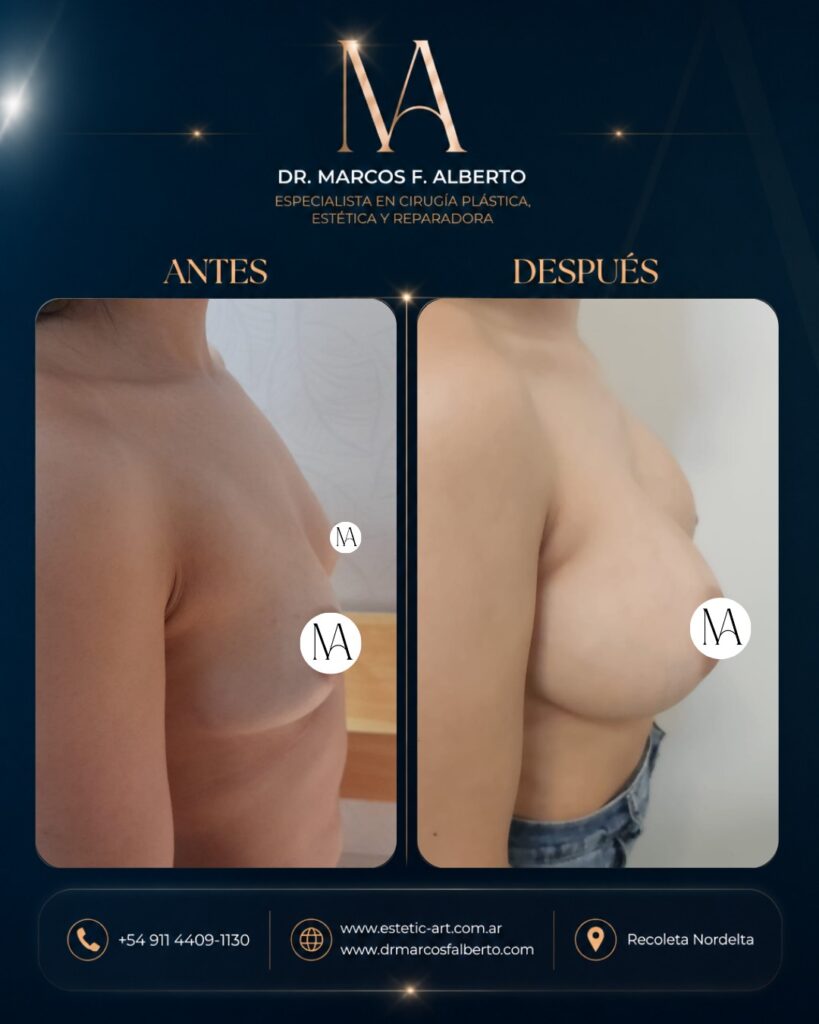 Antes y después de aumento mamario realizado por el Dr. Marcos Fernando Alberto – caso 3