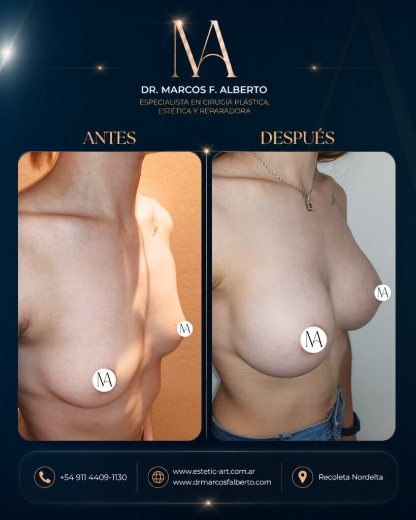 Antes y después de aumento mamario realizado por el Dr. Marcos Fernando Alberto – caso 4