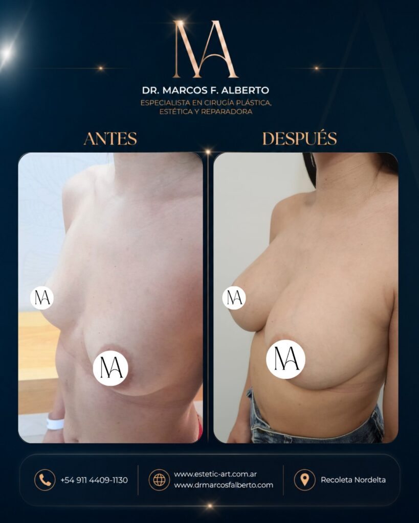 Antes y después de aumento mamario realizado por el Dr. Marcos Fernando Alberto – caso 5