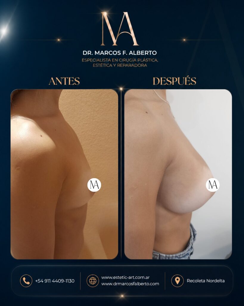 Antes y después de aumento mamario realizado por el Dr. Marcos Fernando Alberto – caso 6