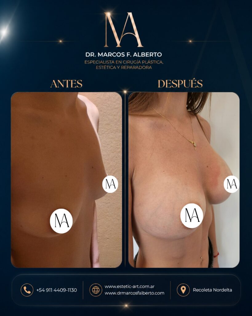 Antes y después de aumento mamario realizado por el Dr. Marcos Fernando Alberto – caso 7